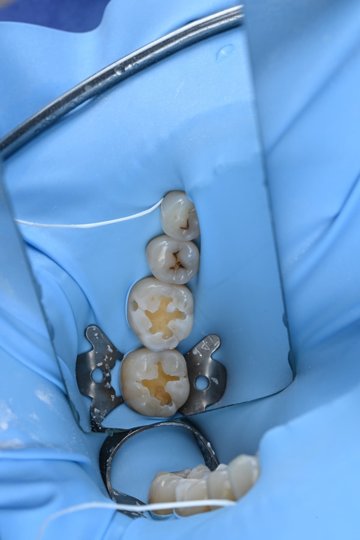 Two damaged molars after removal of old restorations and compromised tissue