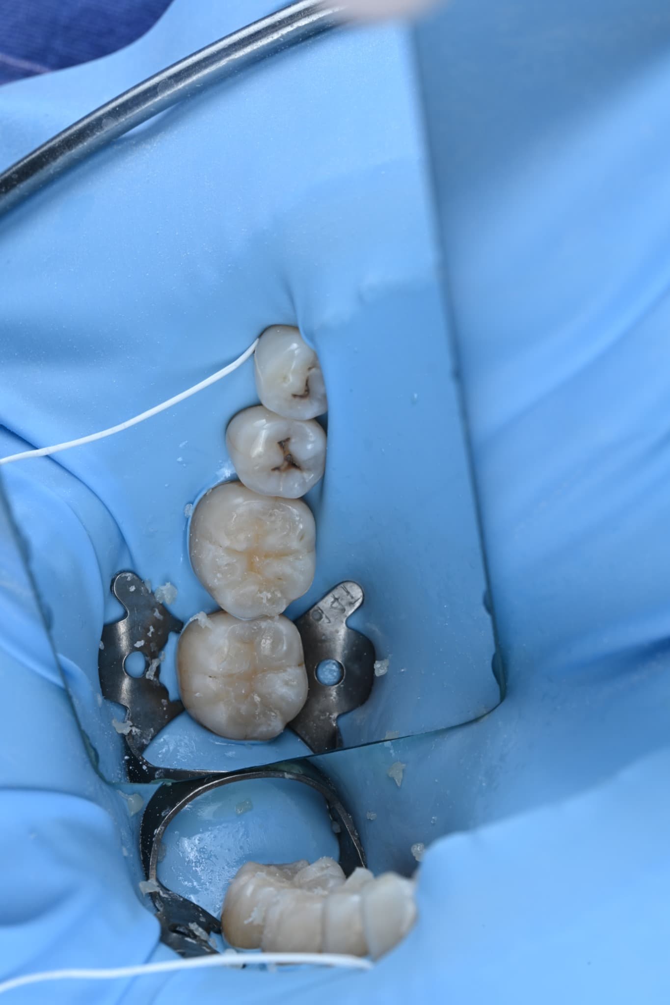 Resin build-up of two molars under rubber dam isolation