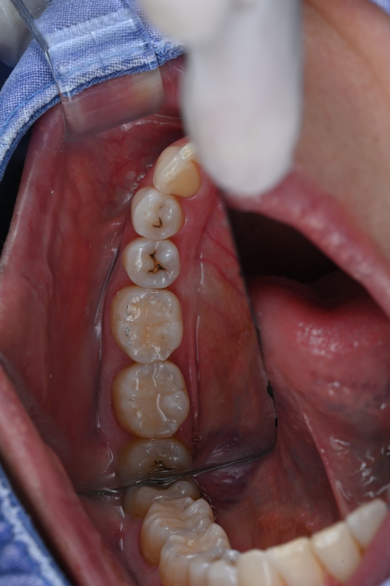 Final form of two molars after direct resin build-up
