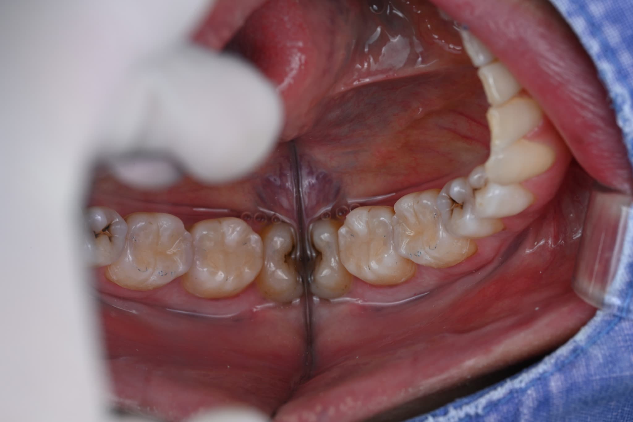 Overall intraoral view after resin build-up of two molars