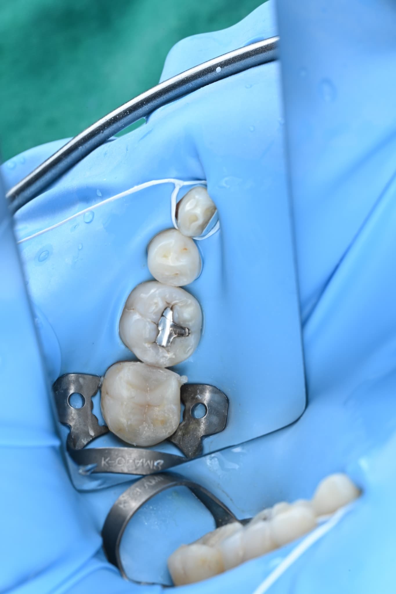 Final resin build-up restoration of a damaged molar