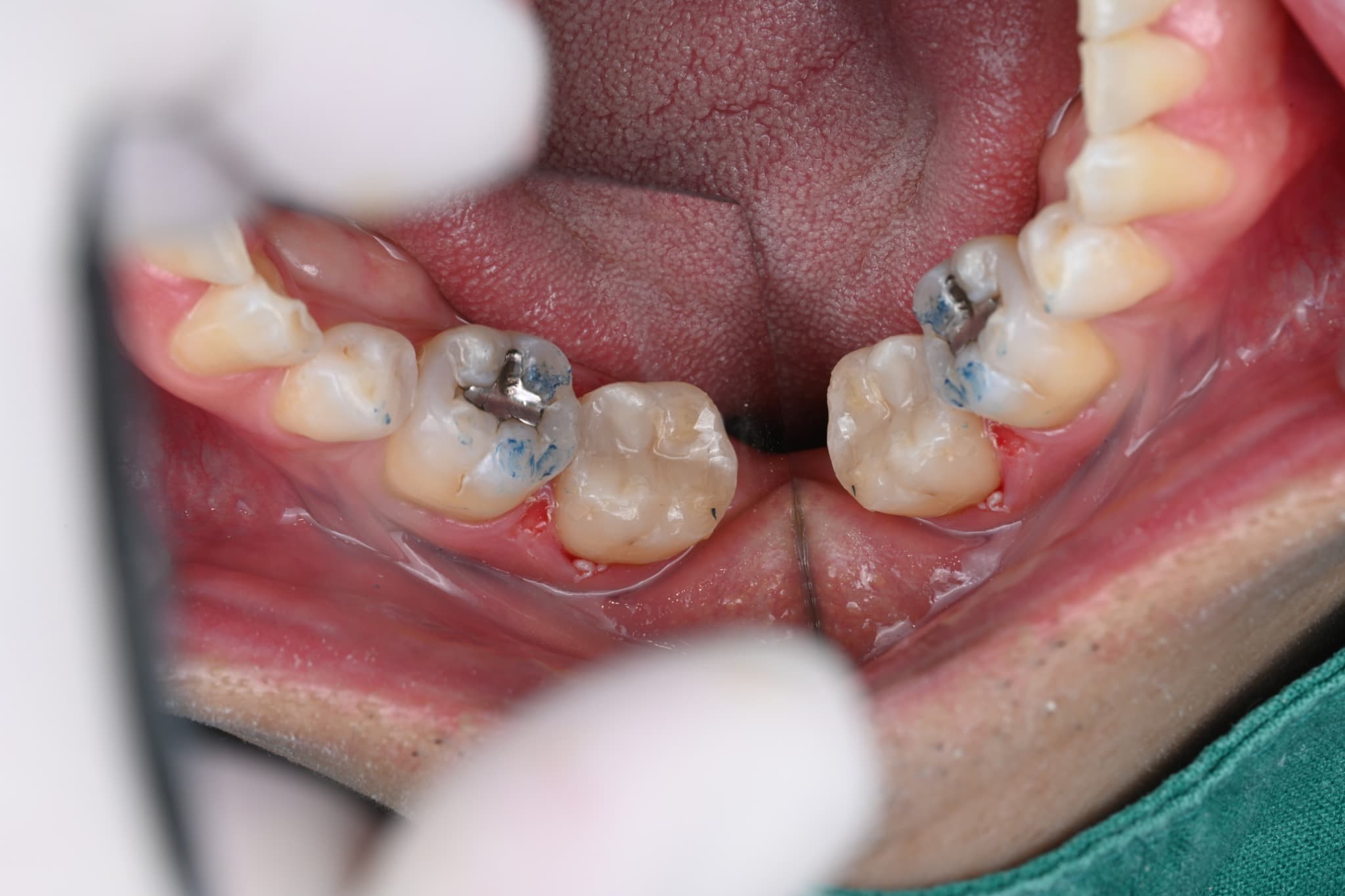 Second molar after resin restoration