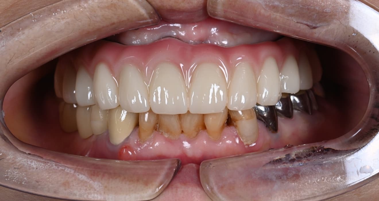 Front intraoral view with an upper fixed full-arch implant restoration