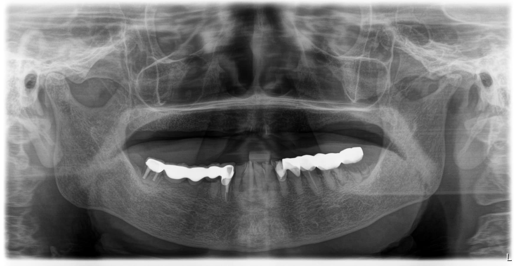 Initial panoramic radiograph showing an edentulous upper jaw and remaining lower teeth