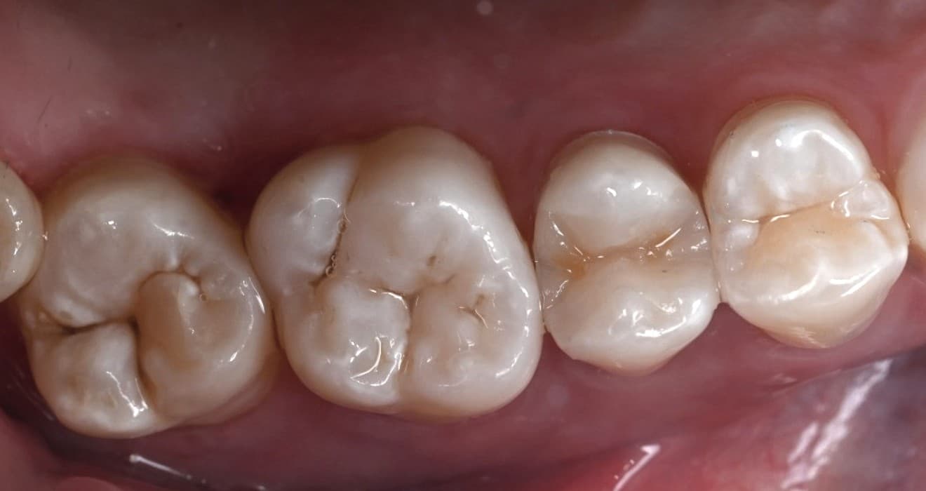 Final intraoral view of tooth 15 after vital pulp therapy and fibre-reinforced resin build-up