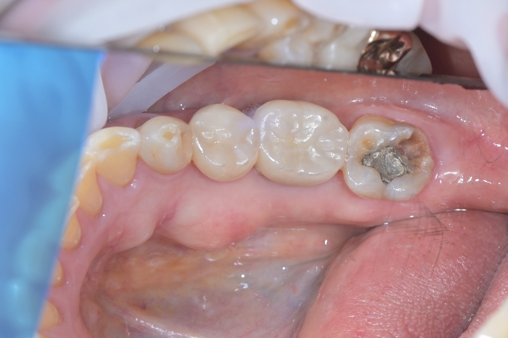 The fractured molar before treatment