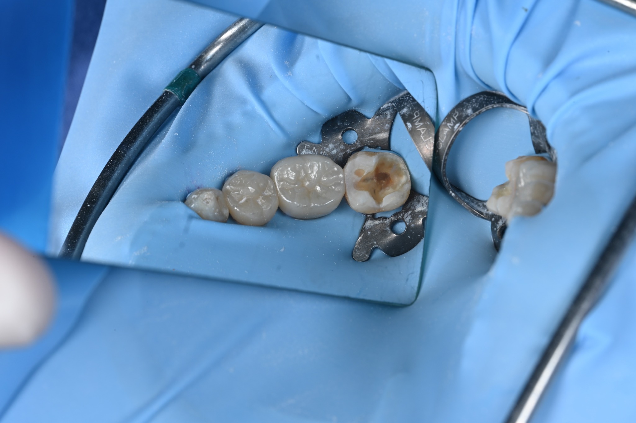 Decay removal under rubber-dam isolation