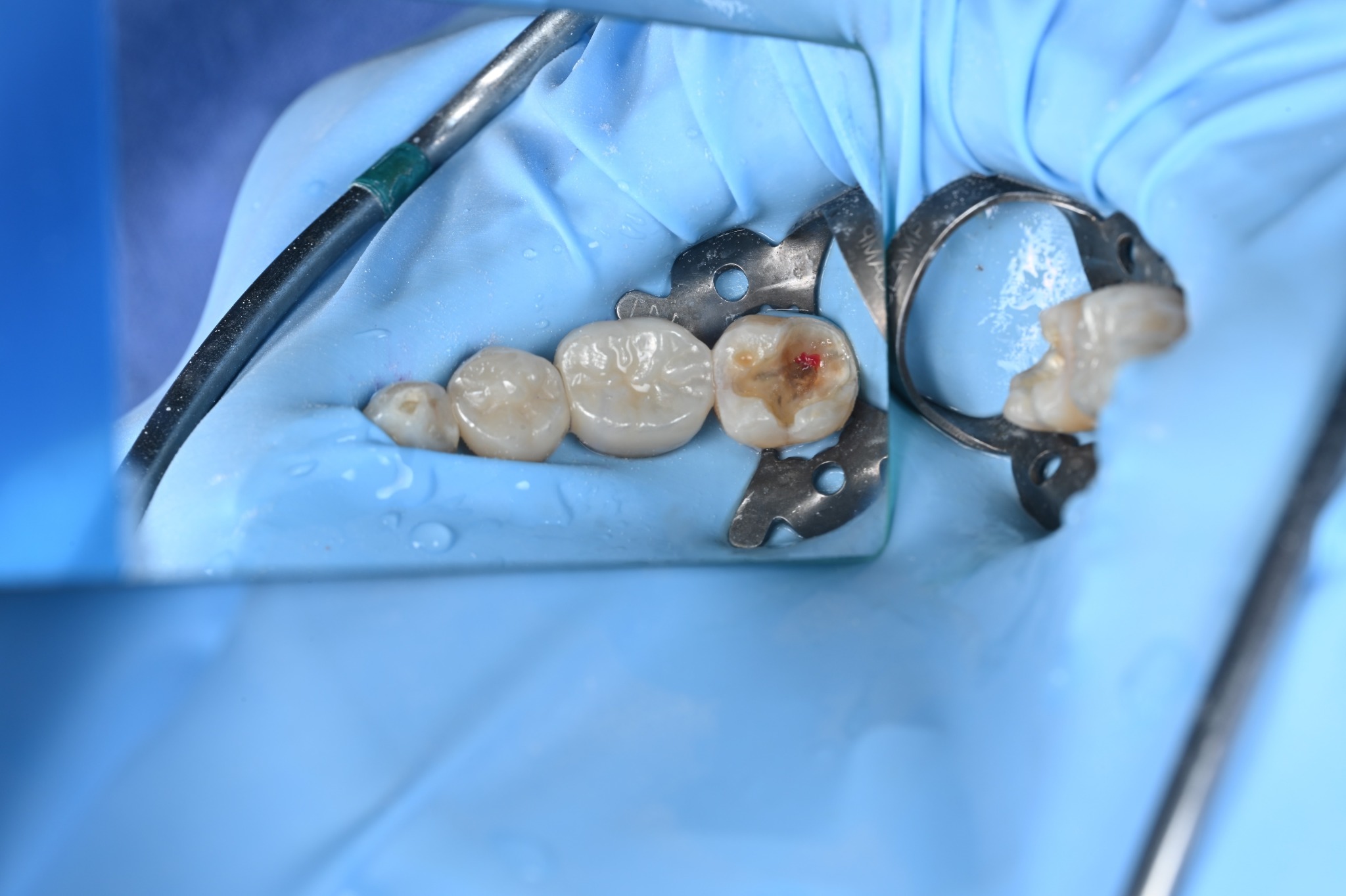 Pulp exposure during decay removal