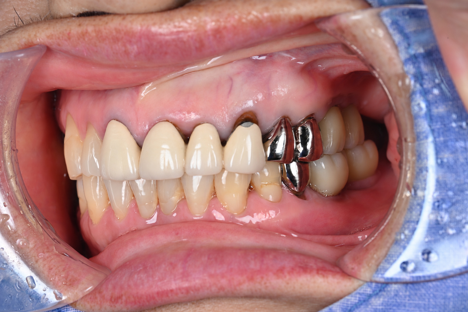 Upper canine before treatment with exposed root and crown margin