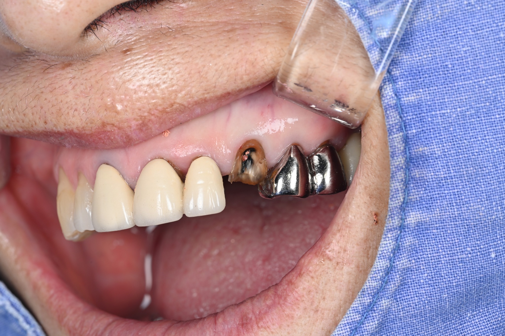 Upper canine and surrounding gums after old crown removal