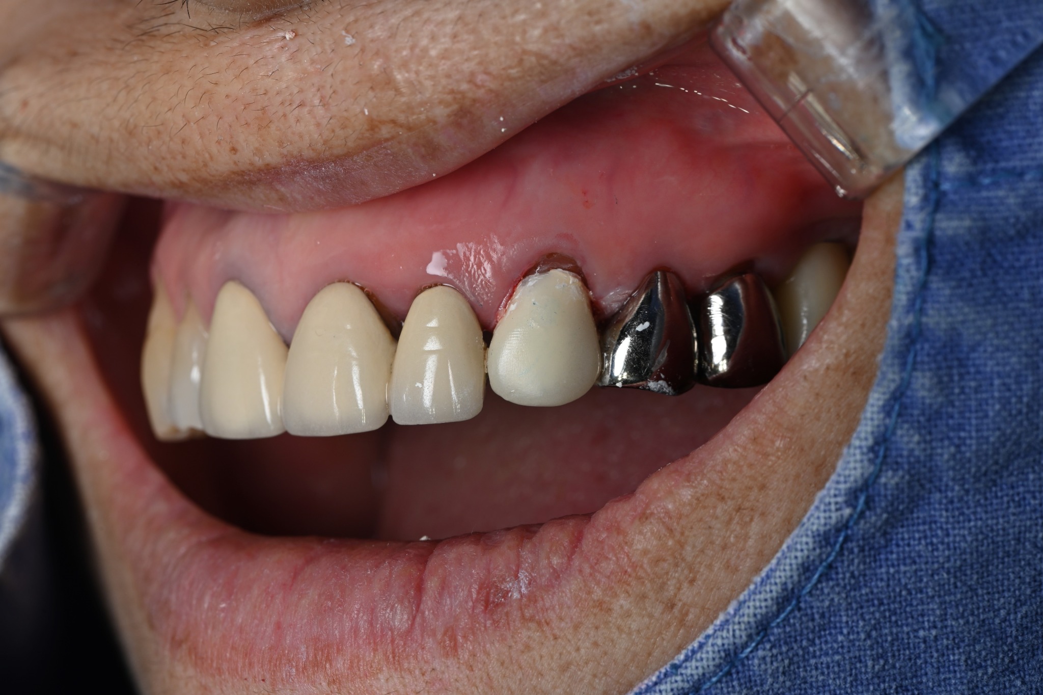 Temporary crown fitted to the upper canine before gum grafting