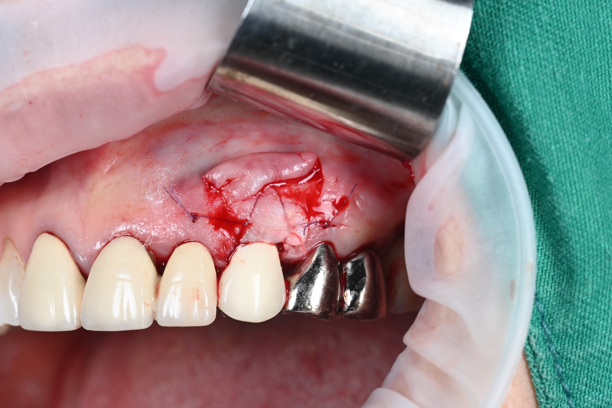 Graft positioned over the exposed canine root during surgery