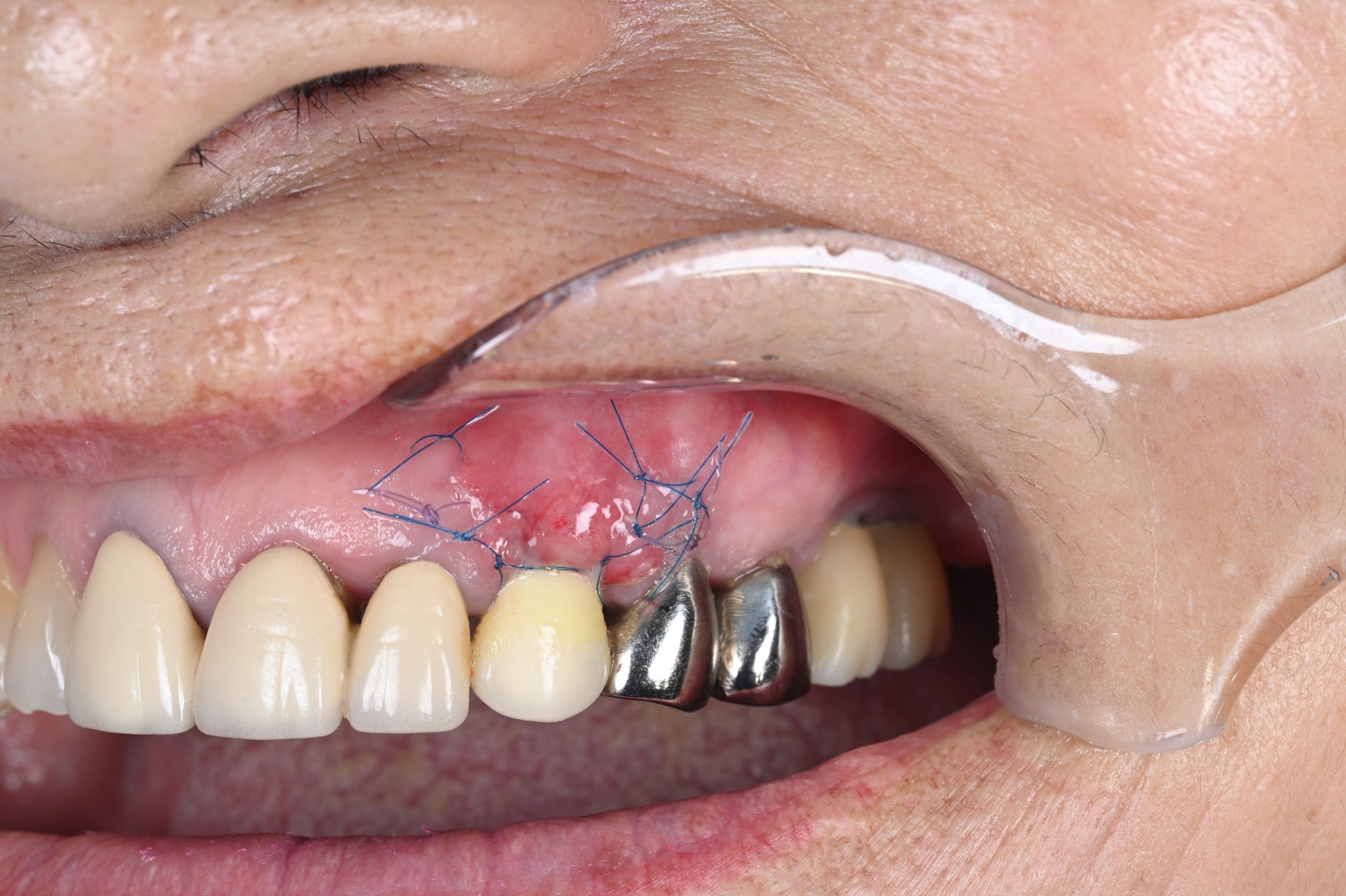 Canine one week after gum grafting, with sutures and a temporary crown
