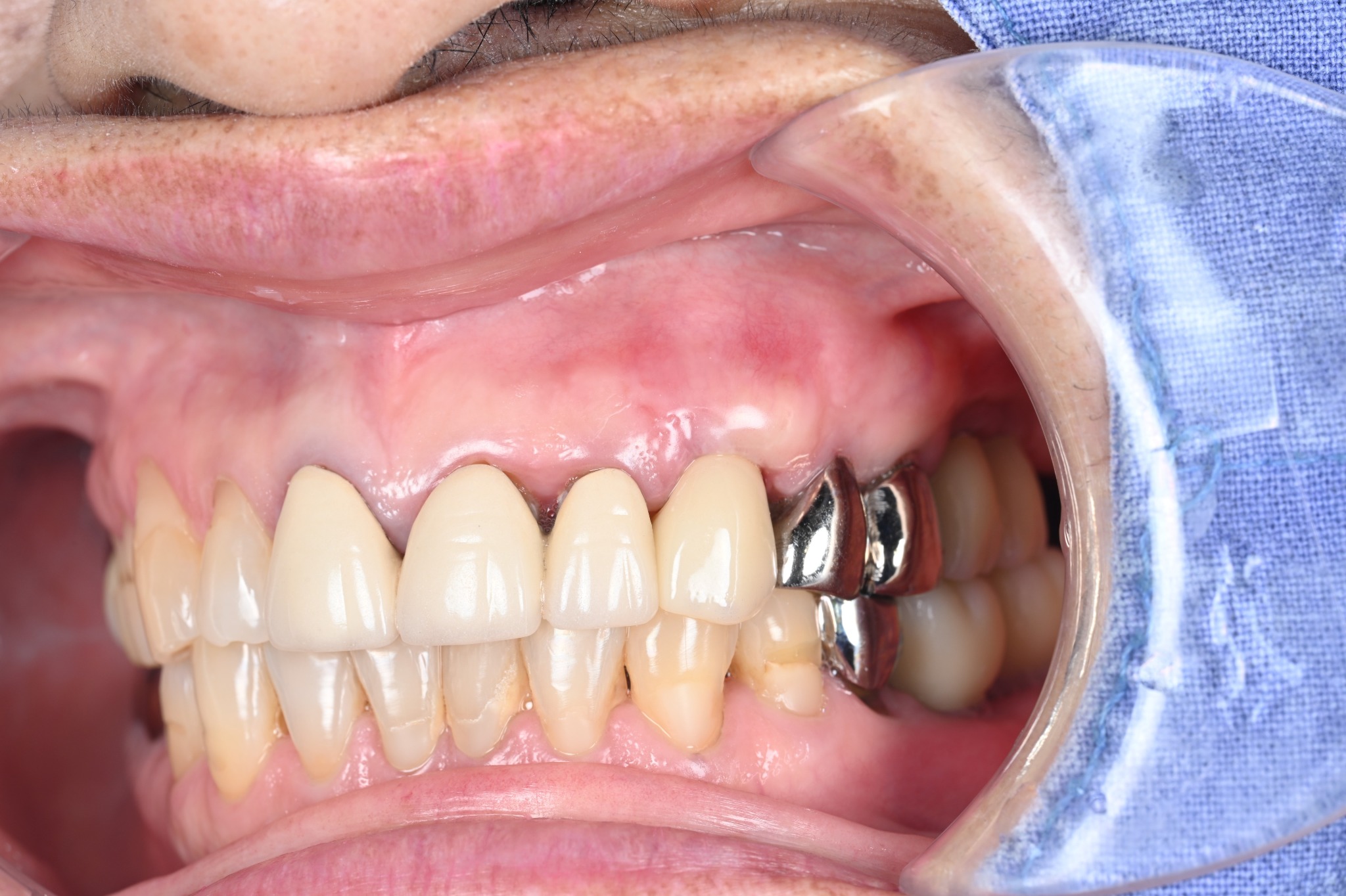 Canine with final crown about three weeks after root coverage