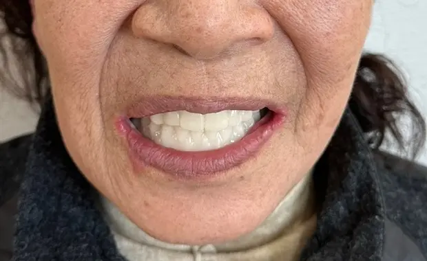 상하악 임시치아를 장착한 뒤 입 주변과 턱까지 보이도록 크롭한 사진